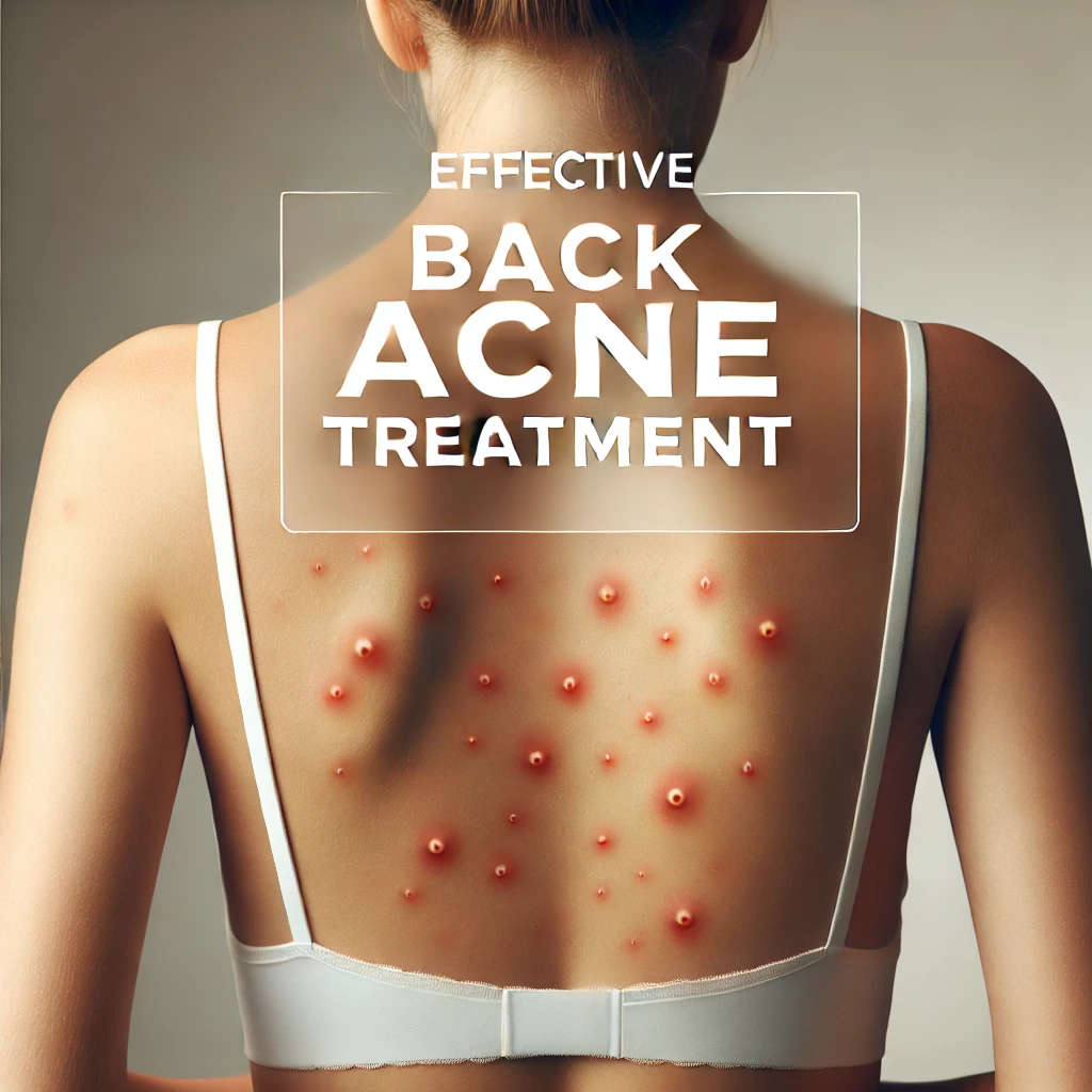 Effective Ways to Get Rid of Back Acne and Itching